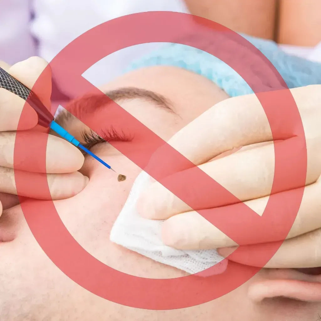 Remove excess marks within 7 days, no surgery, no discomfort, and no $500 clinic fee. - Image 3