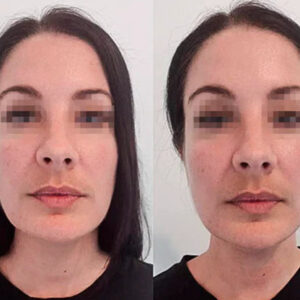Lymphatic Drainage – Refined Face, Lighter Legs, Flat Stomach