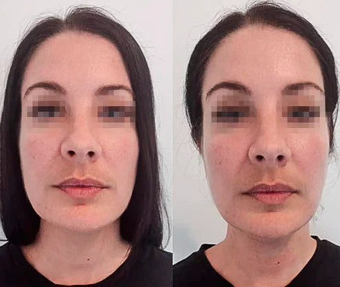 Lymphatic Drainage – Refined Face, Lighter Legs, Flat Stomach